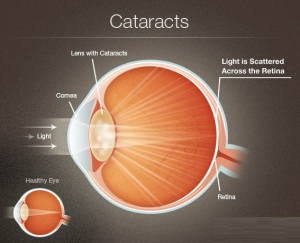 Treatment-for-Cataracts